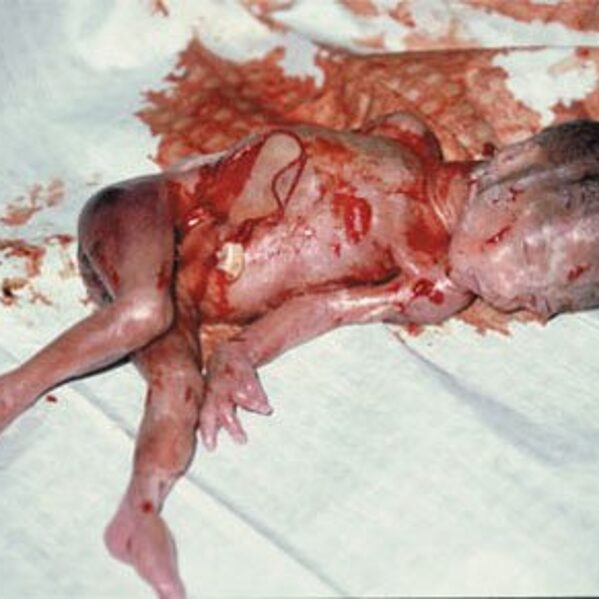 A late-term abortion victim