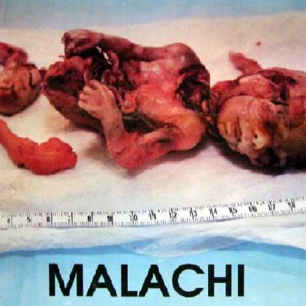 Baby Malachi. Source from 'Priests For Life' site