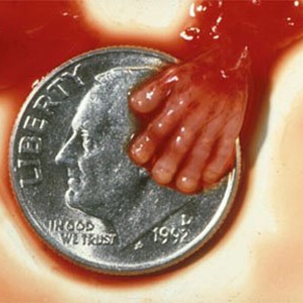 Aborted at first trimester 