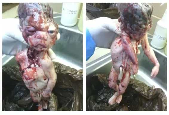 Aborted baby images given to Operation Rescue by former staff at Houston abortion facility