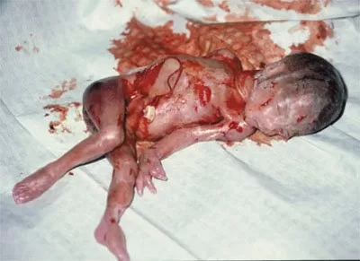 A late-term abortion victim