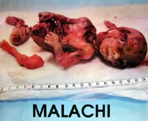 Baby Malachi. Source from 'Priests For Life' site